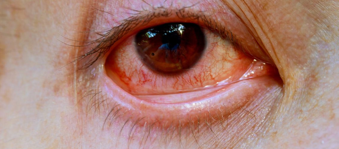 Close up of one annoyed red blood eye of male affected flu, cold or allergy. Concept of health, disease and treatment.