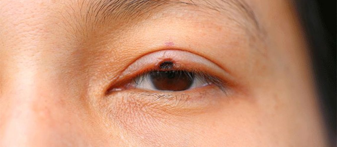 eyelid skin cancer